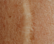 Cicatrice