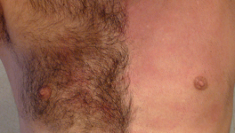 Epilation