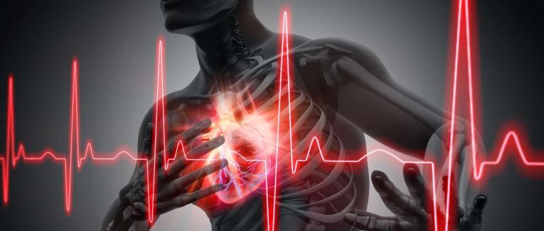 Infarctus