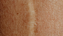 Cicatrice