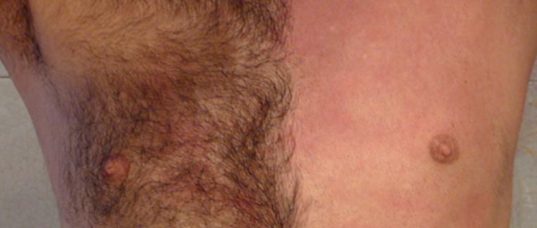 Epilation