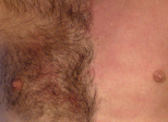 Epilation