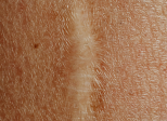 Cicatrice